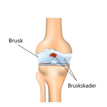 Bruskskader kan både opstå pludseligt og gradvist