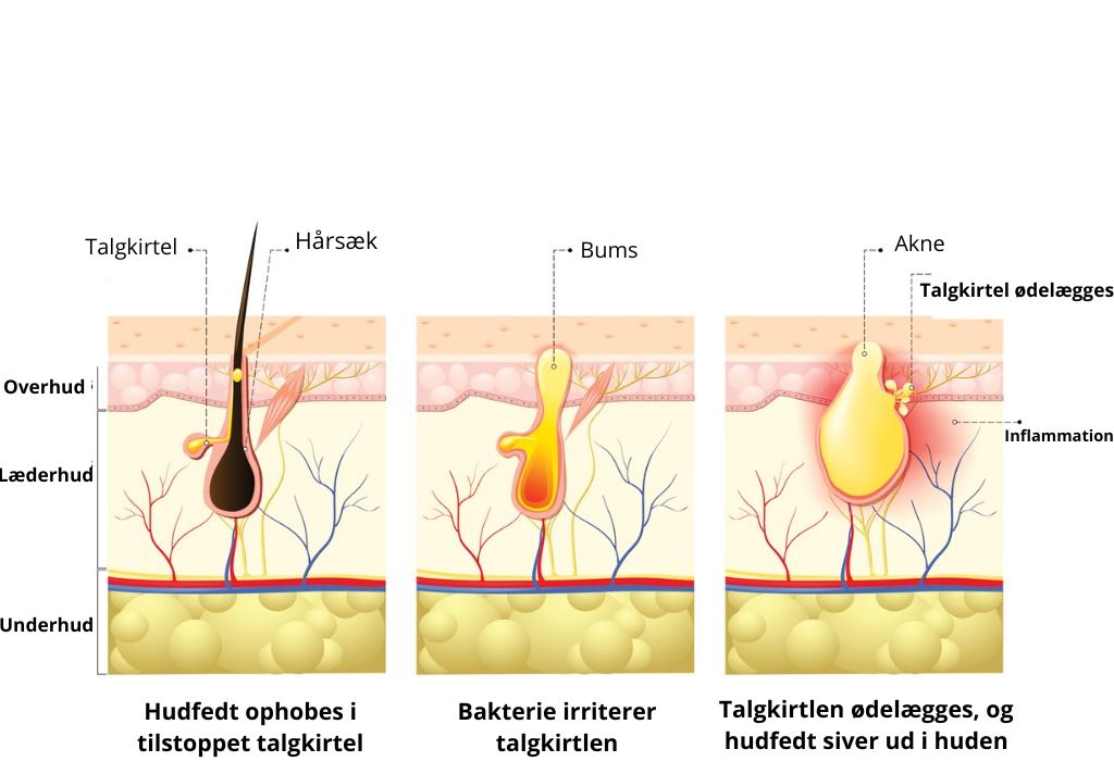Udviklingen af akne