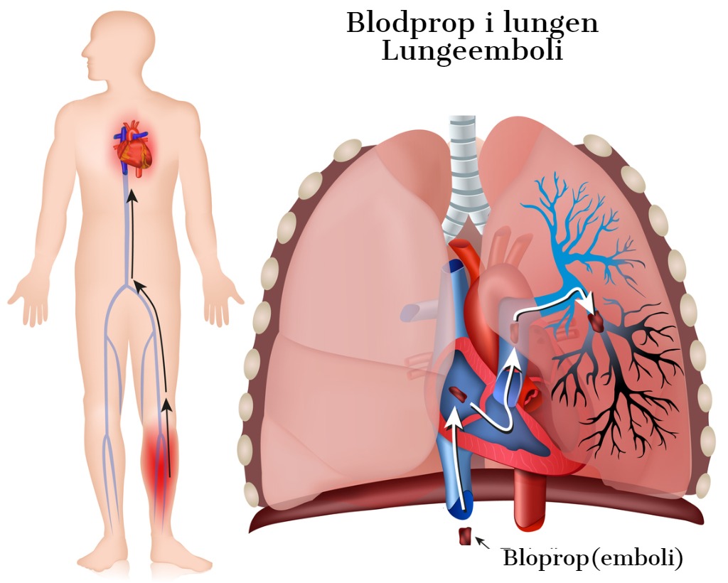 Blodprop i lungen Lungeemboli