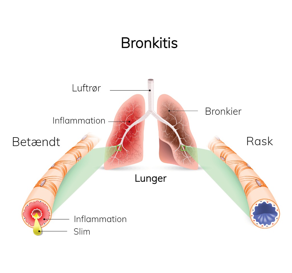 Illustration med tværsnit af en betændt bronkie og en sund bronkie. Foto: iStock
