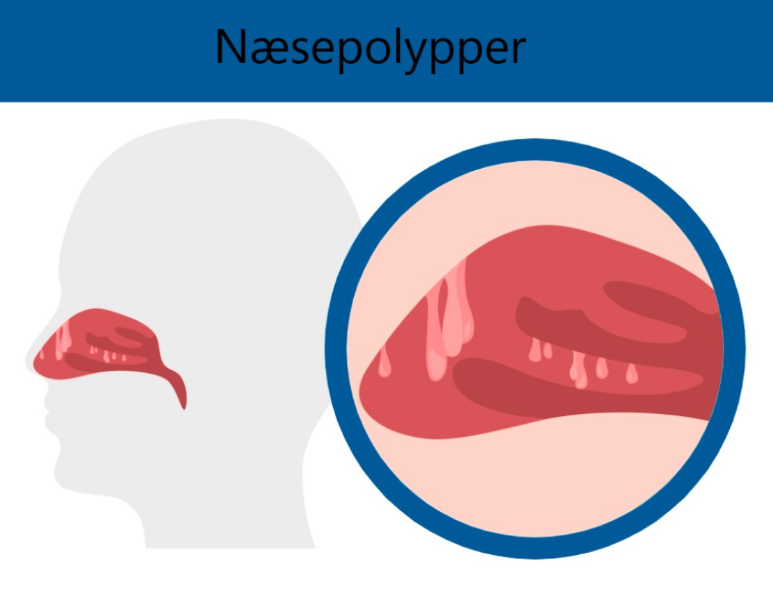 Illustration af næsehulsen og et udsnit, der viser næsepolypper. Foto: iStock