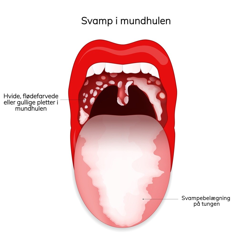 Illustration af svamp i mundhulen (Candidiasis). Billede: iStock