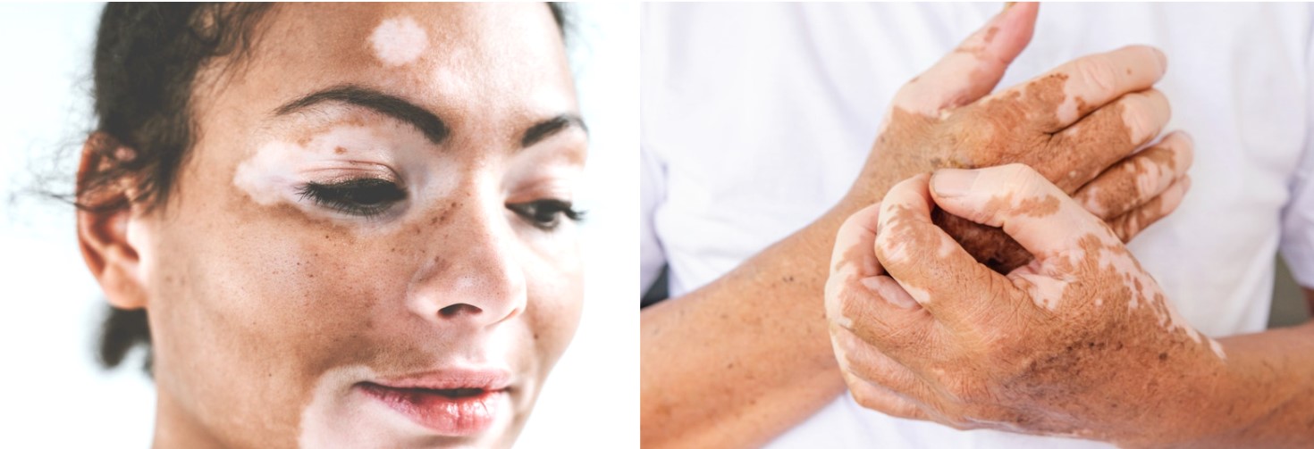 Vitiligo i ansigtet og på hænder. Foto: iStock