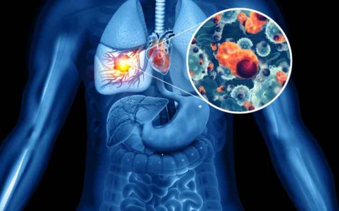 Hvad er de første tegn på lungekræft?