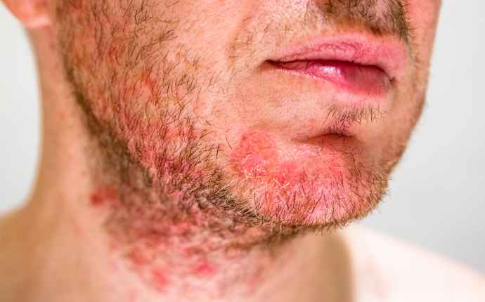 Hvad er seborrheic dermatitis?