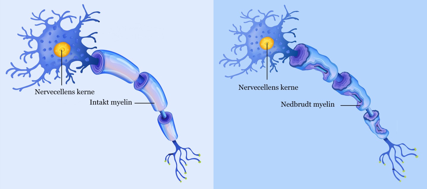 Nervecelle med sclerose, hvor myelinet er ødelagt